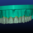 Screenshot_2.png Phantom dental model with single crowns and bridges