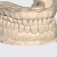 MeditLink_Image_Data_-2.jpg MODELO PEDAGÓGICO DR CAPARACHINI STRAUMANN - NEODENT (INCLUINDO ANÁLOGOS)