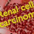 renal-cell-carcinoma-3d-model-6b7b298a6c.jpg Renal cell carcinoma 3D model