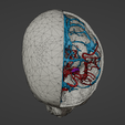 w5.png 3D Model of Brain Arteriovenous Malformation