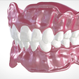 Screenshot_16.png Digital Full Dentures for Gluedin Teeth with Manual Reduction