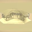 Snapshot_2017-8-30_3-7-52.jpg Digital Elastic Mandibular Advancement Appliance