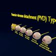 posterior-vitreous-detachment-types-eye-3d-model-blend-28.jpg Posterior vitreous detachment types eye 3D model