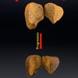 ps16.jpg 3D Alchoholic liver disease cirrhosis hepatitis fatty model