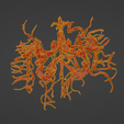 uv15.png 3D Model of Brain Arteriovenous Malformation