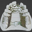 Kennedy-Class-I-Mod-1-Maxillary-7.png Prosthodontics Kennedy Class I Mod 1 Maxillary Removable partial denture (RPD)