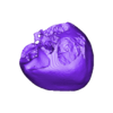 STL00005.stl 3D Model of Human Heart with Pulmonary Artery Sling (PAS) - generated from real patient