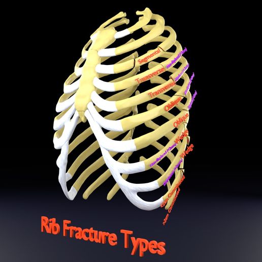STL file Rib fracture and its types 🦴 ・Design to download and 3D print ...