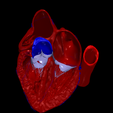 1.png 3D Model of the Heart with Tetralogy of Fallot, parasternal long axis