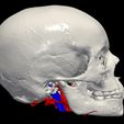 03.jpg 3D Model of Brain Arteriovenous Malformation