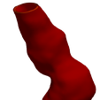 5.png Model of an abdominal aortic aneurysm from a real patient