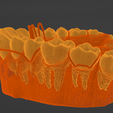teeth,-dental,-habit-breaker,-appliance,-habit-breaking,-orthodontics,-oral,-canines,-premolar,-mola.png High resolution Habit Breaker Two Dental Appliance on Upper teeth