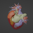 7.png 3D Model of Human Heart with Common Arterial Trunk (CAT) - generated from real patient