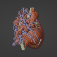 4.png 3D Model of Human Heart with Anomalous Pulmonary Venous Drainage (APVC) - generated from real patient