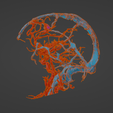 uv8.png 3D Model of Brain Arteriovenous Malformation