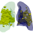 2.png 3D Model of Lungs Infected with Covid19