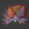 6.png 3D Model of Human Heart with Common Arterial Trunk (CAT) - generated from real patient