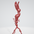 p2.png Case 1 to 6: 3D aortic and iliac artery aneurysm