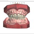 6.jpg Digital Full Dentures for Gluedin Teeth with Manual Reduction