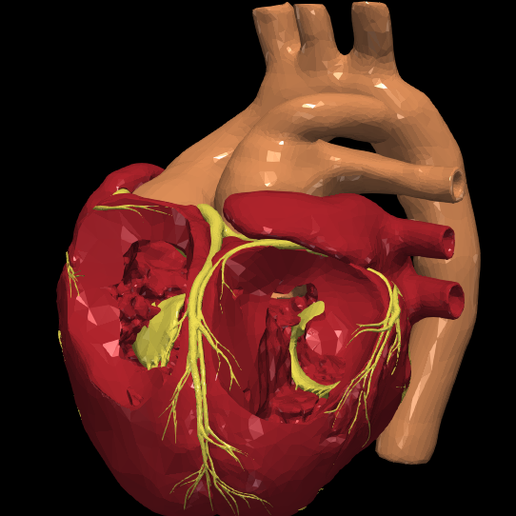10.png 3D Model of Transposition of the Great Arteries Open Duct