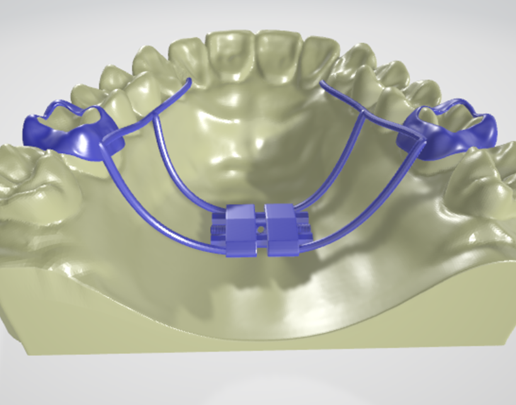 molar-distalizer,-teeth,-dental,-tooth,-palatal-expander,-appliance,-removable,-hilgers,-orthodontic.png High resolution Rapid Palatal Expander (Banded type) Dental appliance on Upper teeth