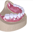16.png Digital Full Dentures with Combined Glue-in Teeth Arch