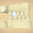 untitled.63.jpg Digital Dental Quadrant  Model with a Full Contour Crown