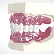 16.jpg Digital Full Dentures for Gluedin Teeth with Manual Reduction