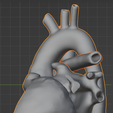 11.png 3D Model of Heart after Fontan Procedure