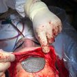 surgical-operation.jpeg A cranial plate to replace a skull defect (an example of a real operation 2)
