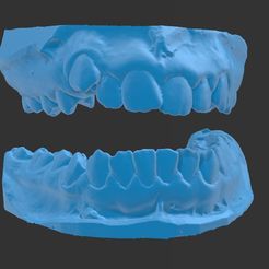 1.jpg Fichier STL Modèle dentaire pédiatrique avec dentition irrégulière・Objet pour imprimante 3D à télécharger