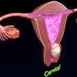 cerv0010.jpg Útero normal frente a tipos de fibromas 3d set