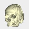 Skull-1.jpg Skull-cranial defect
