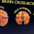ps43.jpg Alzheimer Disease Brain coronal slice