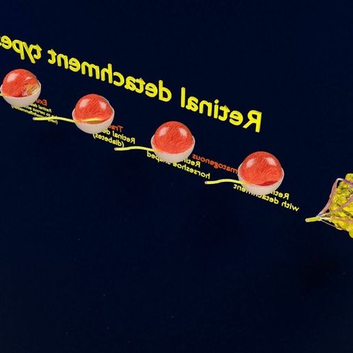 retinal-detachment-types-eye-3d-model-blend-75.jpg Retinal detachment types eye 3D model