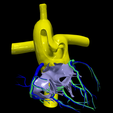 8.png 3D Model of Common Arterial Trunk Truncus Arteriosus