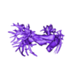 STL00003.stl 3D Model of Human Heart with Anomalous Pulmonary Venous Drainage (APVC) - generated from real patient