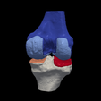 1.png 3D Model of Knee - generated from a real patient