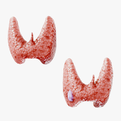 Thyroid__Tumbnail.png Fichier 3D Thyroïde saine et cancer de la thyroïde・Objet pour imprimante 3D à télécharger