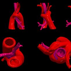 0.jpg 3D Model of Double Aortic Arch