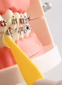 Captura-de-pantalla-2025-06-30-192203.png Placement of orthodontic elastics