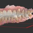 1.jpg colored dental models with periodontitis