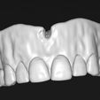 up.jpg Digital total dentures