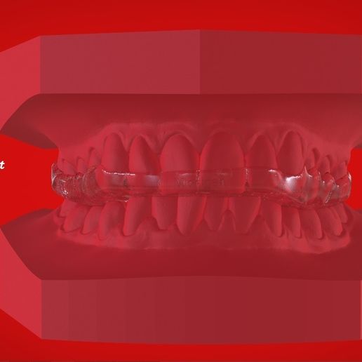 Digital Michigan Splint for 3D Printing