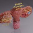 image-0004.jpg Krukenberg ovarian cancer tumor