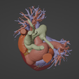 7.png 3D Model of Human Heart with Atrial Septal Defect (ASD) - generated from real patient