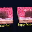 gastric-stomach-cancer-stages-labelled-3d-model-7d6a3b99c3.jpg Gastric stomach cancer stages labelled 3D model