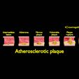 ps0005.jpg Artère Plaque d'athérosclérose et conséquences