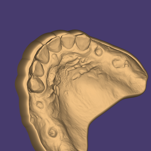 Screenshot_20240307_150520_exocad-webview.png Digital RPD Model