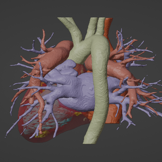 4.png Modèle 3D de cœur humain avec transposition des grandes artères (TGA) - généré à partir d'un patient réel